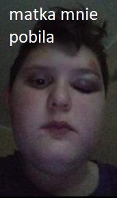 podbite_oko_smarr.gif.cec7deeb907b120a3d51f458390d6435.gif